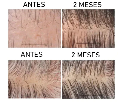 1+1 GRATIS| SPRAY PARA ALOPECIA - HyperSpray™