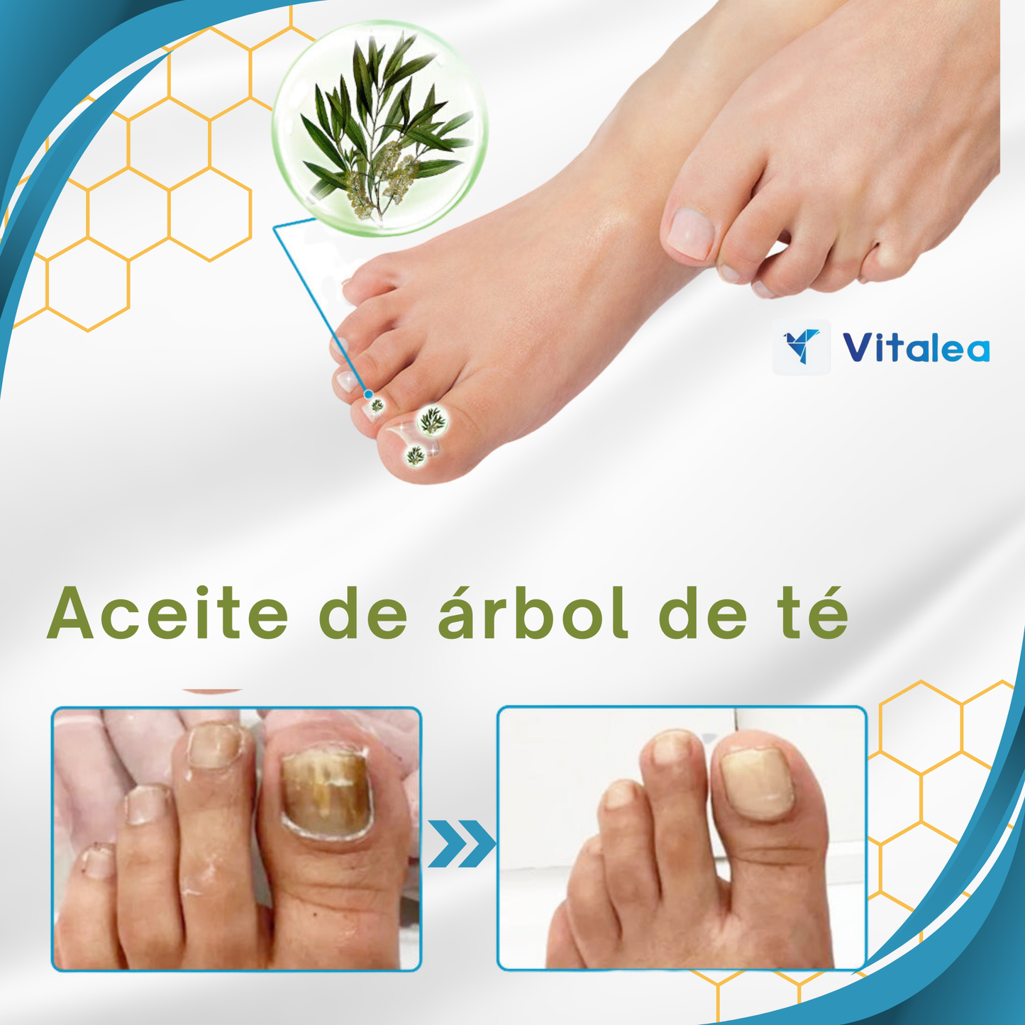 🐝 BeeNail Rescue™ Solución para el tratamiento de hongos en las uñas de veneno de abeja 🐝