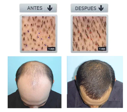 1+1 GRATIS| SPRAY PARA ALOPECIA - HyperSpray™