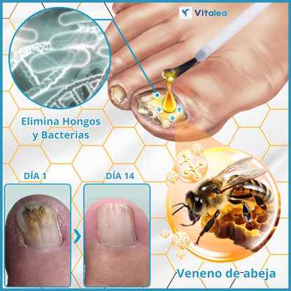 🐝 BeeNail Rescue™ Solución para el tratamiento de hongos en las uñas de veneno de abeja 🐝