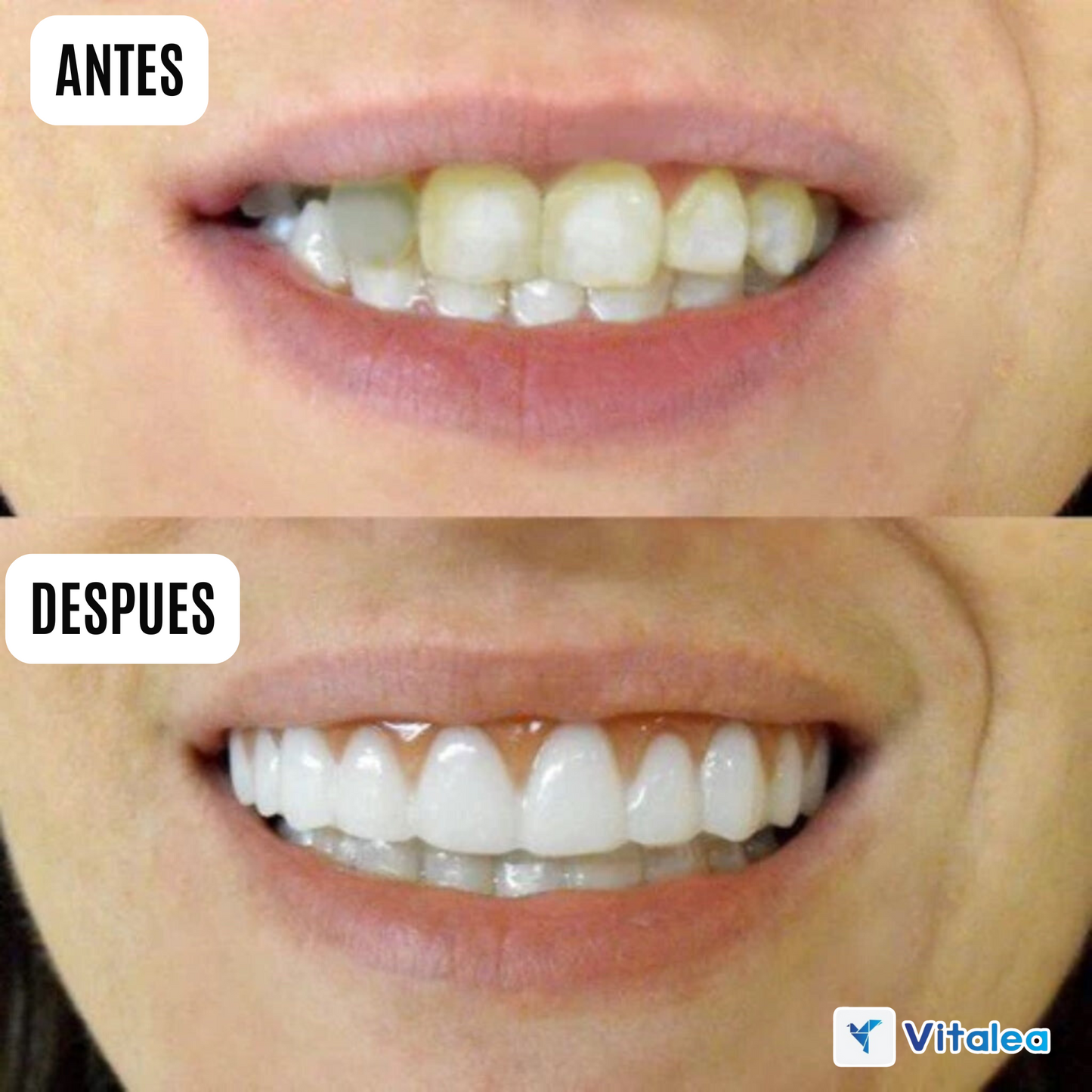 😁🦷Prótesis universales (talla única, se adapta a la boca)🦷😁