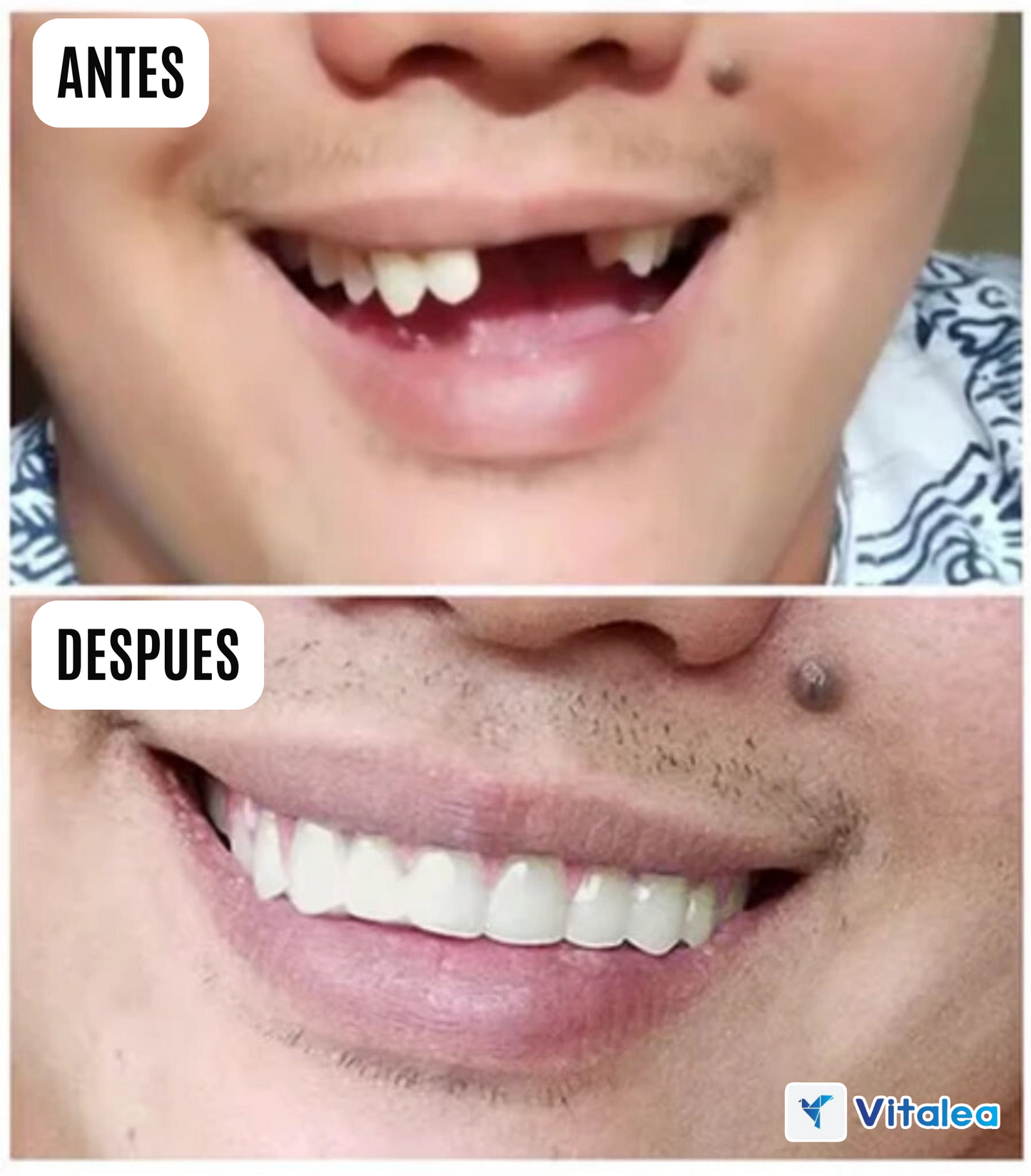 😁🦷Prótesis universales (talla única, se adapta a la boca)🦷😁