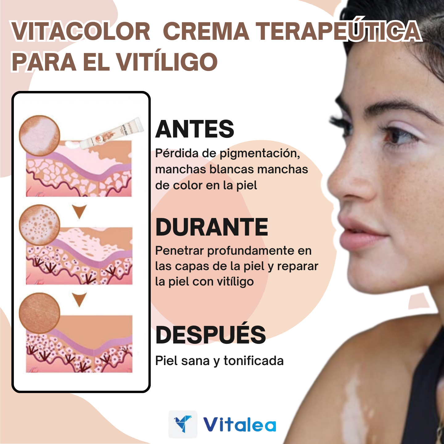 ✨🧴 VitaColor  - Crema terapeútica para el Vitíligo🧴✨