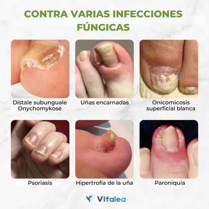 🛡️💅🏻Aceite para tratamiento de uñas con veneno de abeja Fivfivgo™ FungiVanish💅🏻🛡️