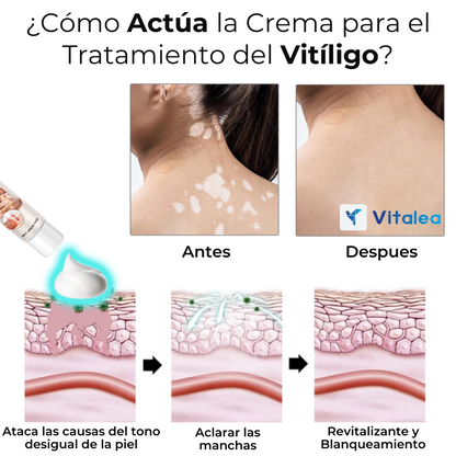 🧴DermaGlow™ Crema para el tratamiento del vitíligo con escualeno🧴