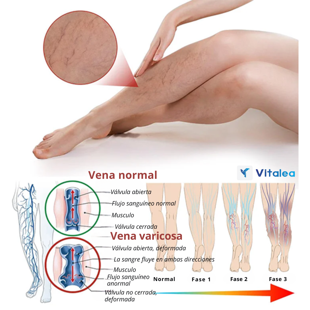 🩹CuraVarix: El tratamiento natural para unas piernas sin varices🩹