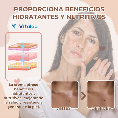 ✨🧴 VitaColor  - Crema terapeútica para el Vitíligo🧴✨