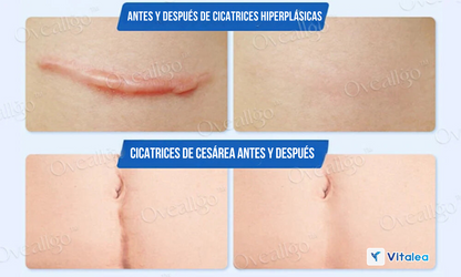 💫Oveallgo™ Crema Antiescaras de Sílice - ¡Disfruta de una piel clara y radiante!💫