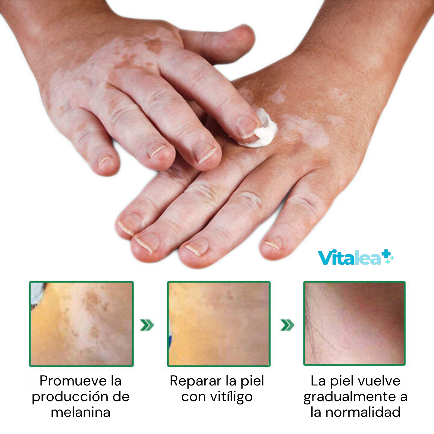 🌿Elixir revitalizante para el vitíligo Fivfivgo™🌿