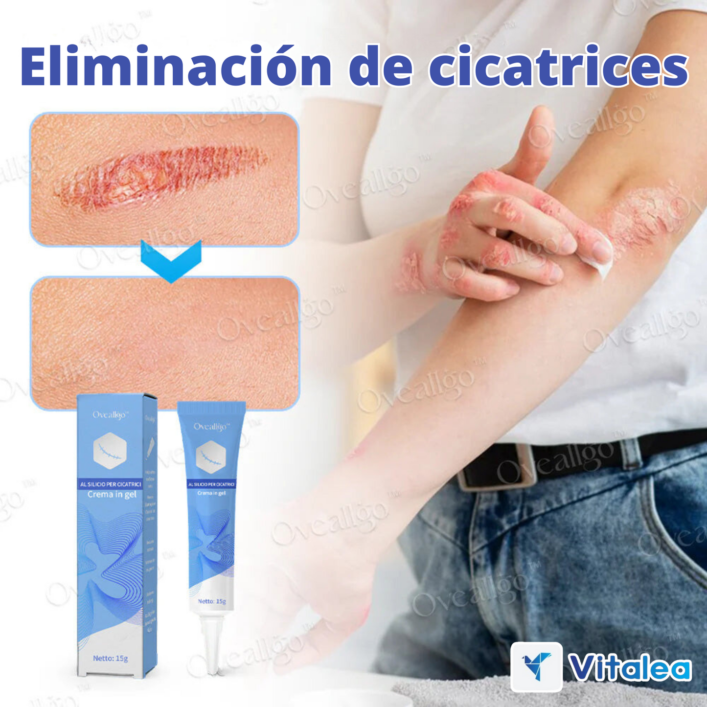 💫Oveallgo™ Crema Antiescaras de Sílice - ¡Disfruta de una piel clara y radiante!💫