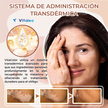 ✨🧴 VitaColor  - Crema terapeútica para el Vitíligo🧴✨