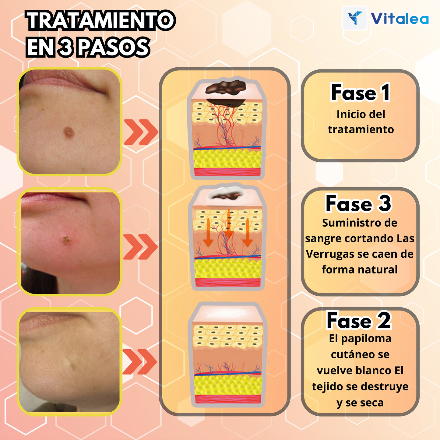 ⛫💨TagRecede™ | 🛇 Elimina las verrugas de forma natural⛫💨