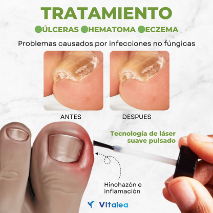 🛡️💅🏻Aceite para tratamiento de uñas con veneno de abeja Fivfivgo™ FungiVanish💅🏻🛡️