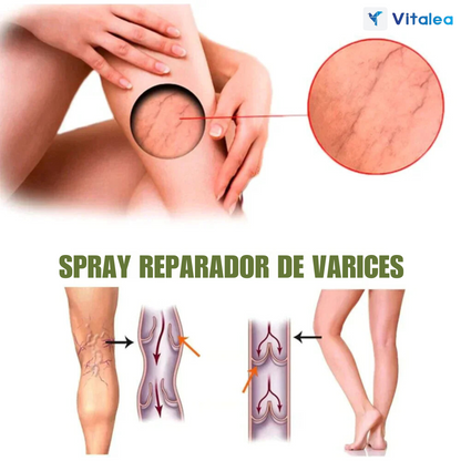 VarixEase™™ Spray para venas varicosas 1 + 1 GRATIS